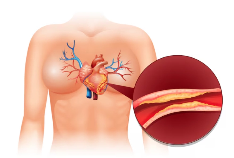 Bệnh mạch vành là nguyên nhân phổ biến gây ra tình trạng suy tim mạn