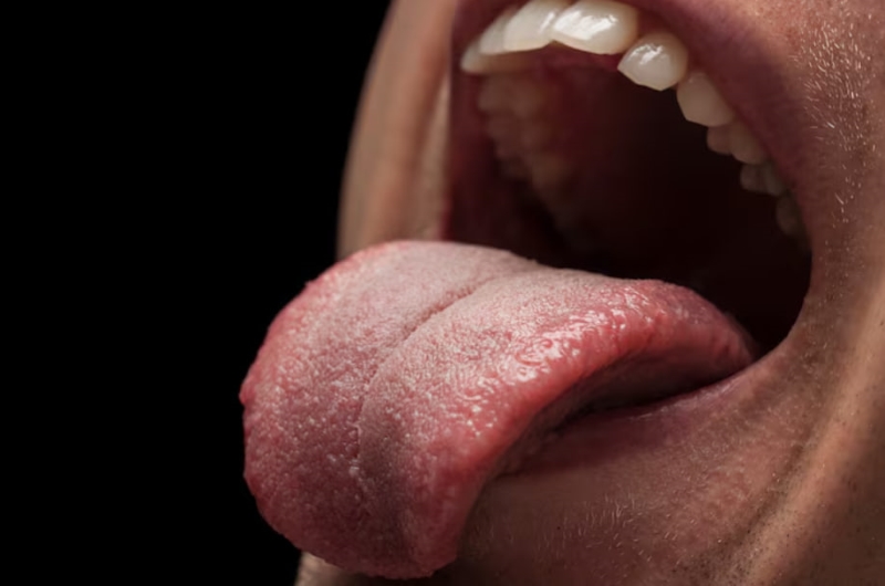 Tình trạng lưỡi bị nứt và nổi nốt xảy ra ở nam giới nhiều hơn nữ giới