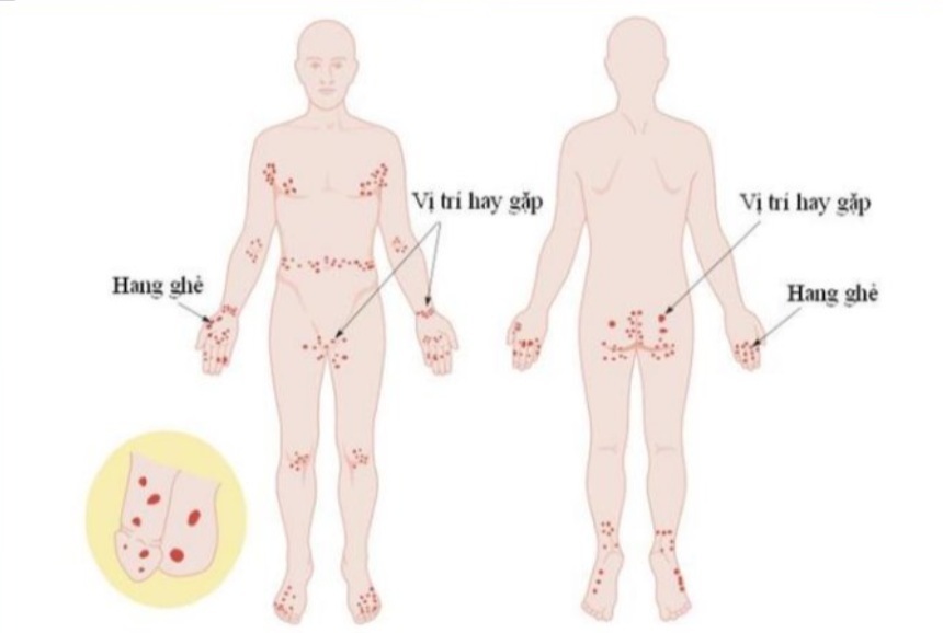 Những vị trí ký sinh trùng ghẻ thường gây bệnh. Ảnh minh họa