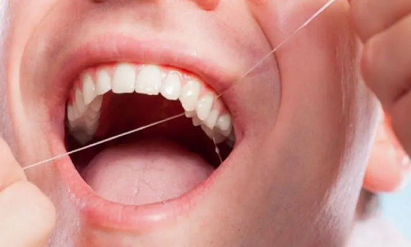 Những điều cần biết về dùng chỉ nha khoa có làm thưa răng 