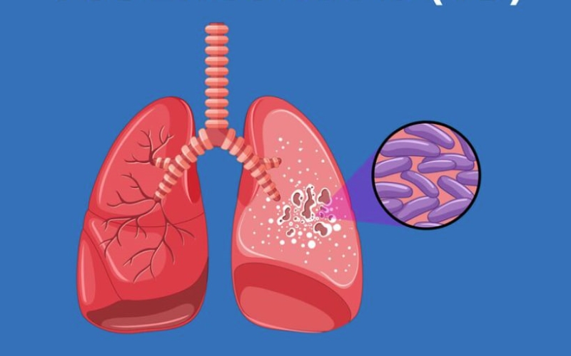 Bệnh lý nhiễm trùng mạn tính như lao là một trong những nguyên nhân khiến chỉ số MONO tăng cao 
