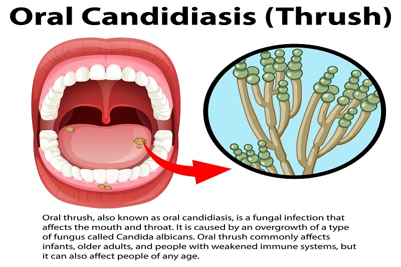 Rau ngót không thể loại bỏ nấm Candida gây tưa lưỡi ở trẻ
