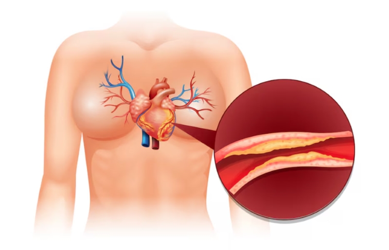 Chụp MSCT mạch vành giúp phát hiện sớm các bệnh mạch vành