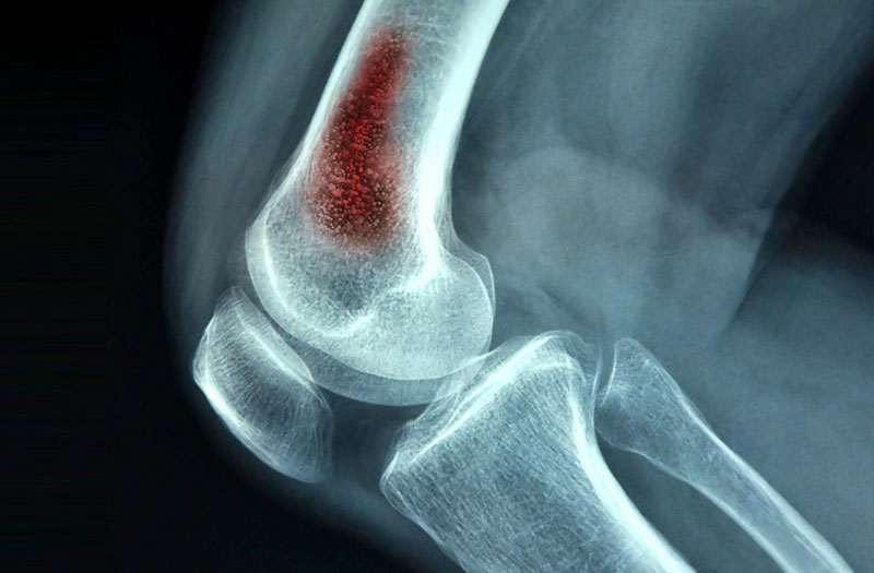 Có những điều kiện sức khỏe nào có thể gia tăng nguy cơ viêm xương?
