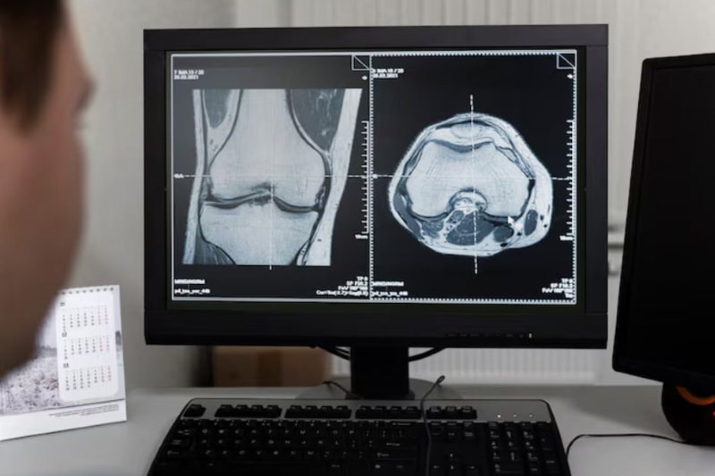 Chụp MRI khớp gối là kỹ thuật được ứng dụng trong việc đánh giá tình trạng khớp gối và các bệnh lý liên quan