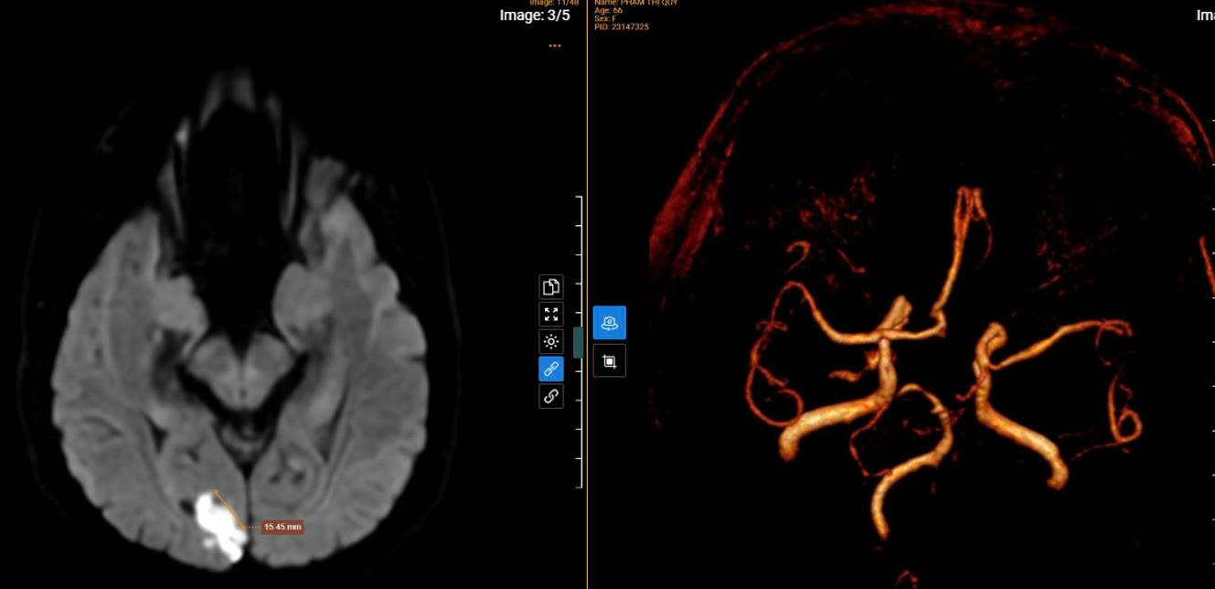 Kết quả MRI tại MEDLATEC xác định nguyên nhân những cơn chóng mặt kéo dài của người bệnh là nhồi máu não cấp