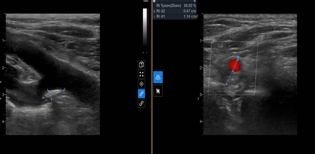 Hình ảnh siêu âm Doppler tại MEDLATEC phát hiện tổn thương xơ vữa động mạch cảnh của người bệnh 