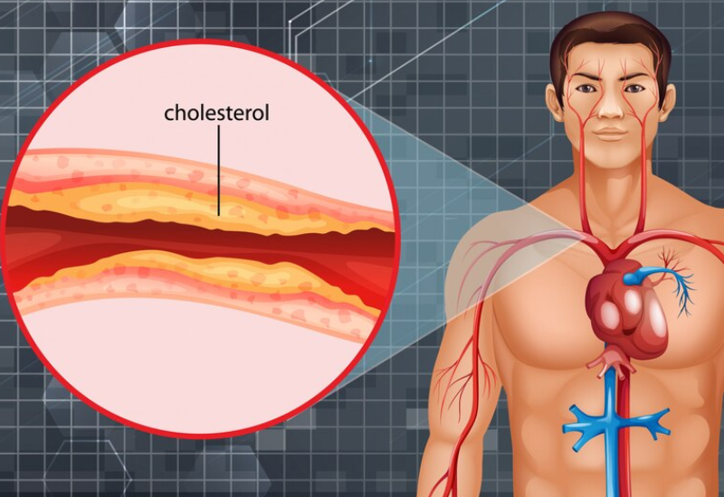 Xơ vữa gây hẹp động mạch cảnh là nguyên nhân phổ biến dẫn đến đột quỵ thiếu máu não. Ảnh minh họa, nguồn Internet