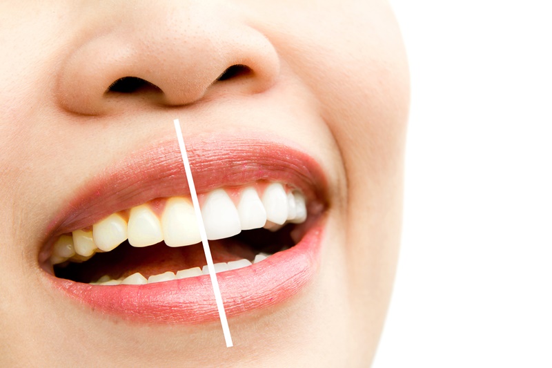 Nhiều phương pháp tẩy trắng răng hiện đại có thể giúp răng trắng sáng trong thời gian ngắn