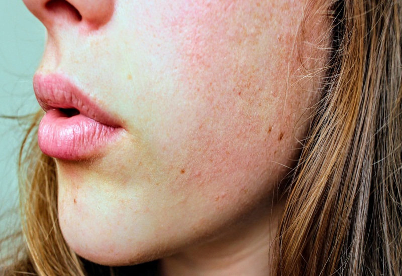 Các lưu ý khi sử dụng hóa mỹ phẩm để tránh dị ứng da mặt nổi sần?
