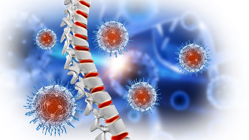 Lao cột sống là bệnh lý do vi khuẩn lao Mycobacterium tuberculosis gây ra
