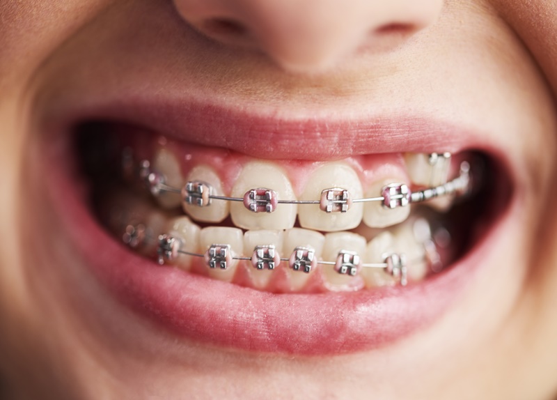 Niềng răng là cách điều chỉnh khớp cắn thường được áp dụng và có thể mang lại hiệu quả tích cực