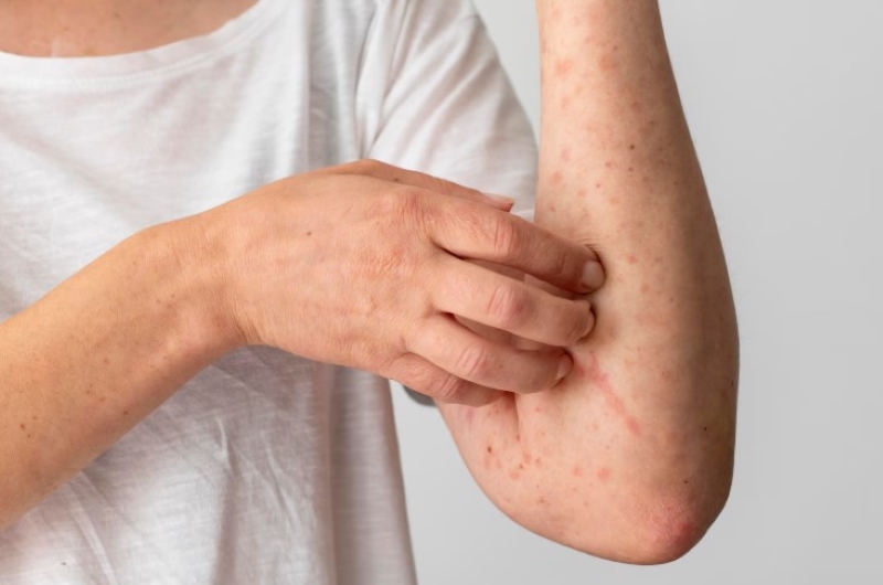 Tiêm vắc xin zona thần kinh là cách hiệu quả giúp giảm nguy cơ mắc bệnh