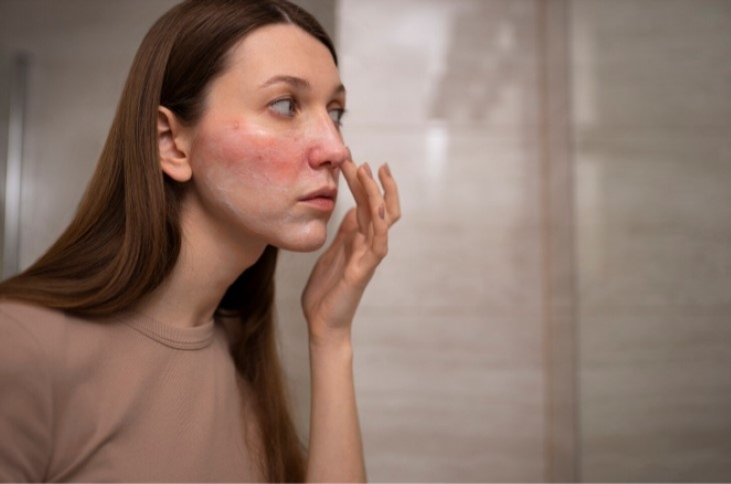 Peel da sinh học có thể gây tình trạng dị ứng hoặc nhiễm trùng nếu không thực hiện đúng cách 