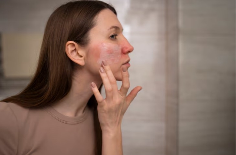 Kiểm tra và theo dõi chặt chẽ phản ứng của làn da sau khi thực hiện peel da