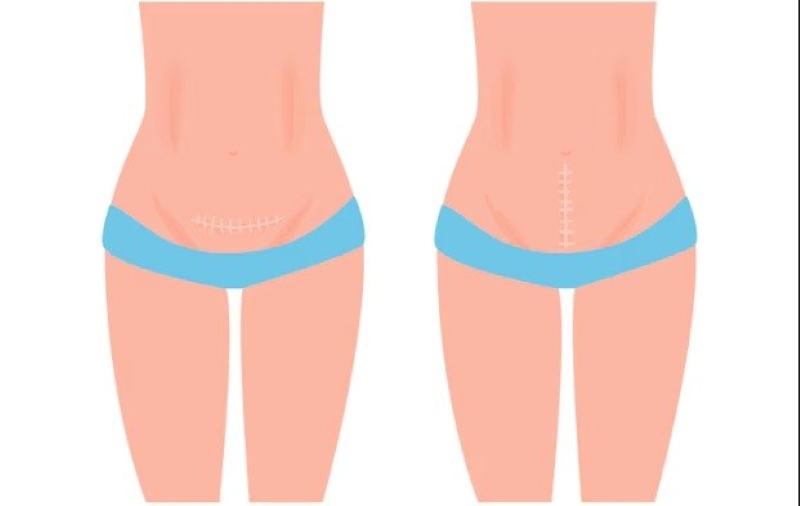 Cơ địa có thể là nguyên nhân hình thành sẹo lồi sau sinh mổ