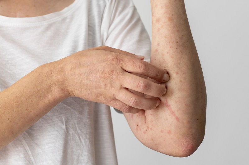 Nổi mày đay có thể do nhiều nguyên nhân gây ra