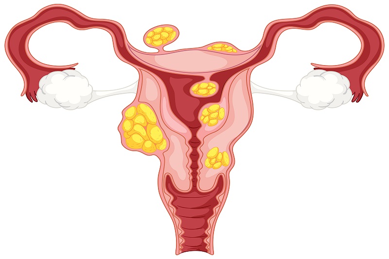 Kích thước càng lớn, nhân xơ tử cung FIGO 5 càng dễ chèn ép cơ quan lân cận