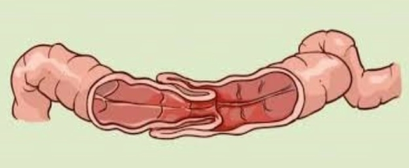 Ảnh minh họa chứng lồng ruột ở trẻ nhỏ (Ảnh bác sĩ cung cấp)  