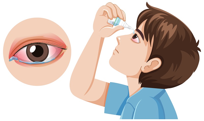 Tuân thủ chỉ định dùng thuốc của bác sĩ có vai trò quan trọng đối với hiệu quả hồi phục sau cắt mộng mắt 