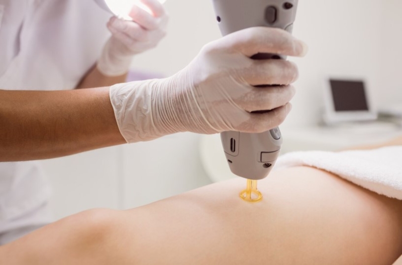 Liệu pháp Laser là một trong những phương pháp điều trị sẹo sau thủy đậu
