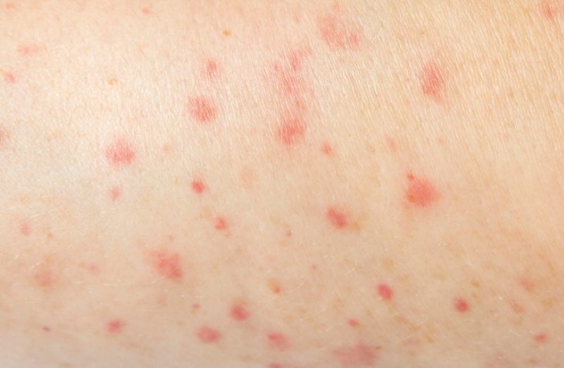 Trẻ bị tay chân miệng bao lâu thì khỏi - thắc mắc nhiều bậc phụ huynh quan tâm
