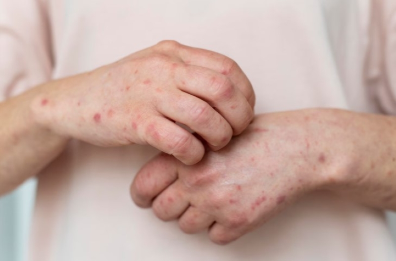 Tránh để trẻ gãi vào các nốt mụn nước trên da