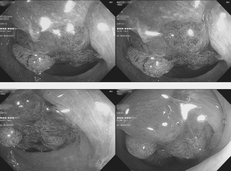 Khối polyp với kích thước lớn được phát hiện trên hình ảnh nội soi  