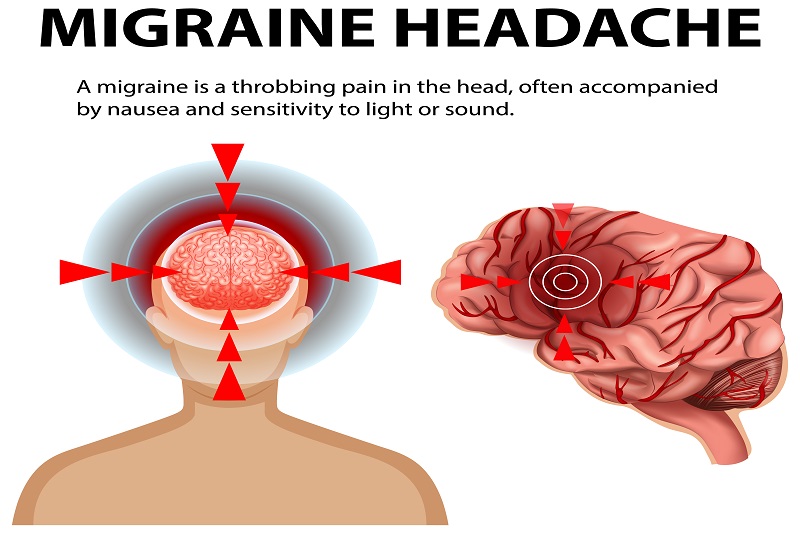 Người mắc bệnh Migraine có thể bị khởi phát cơn đau đầu sau khi tắm biển 
