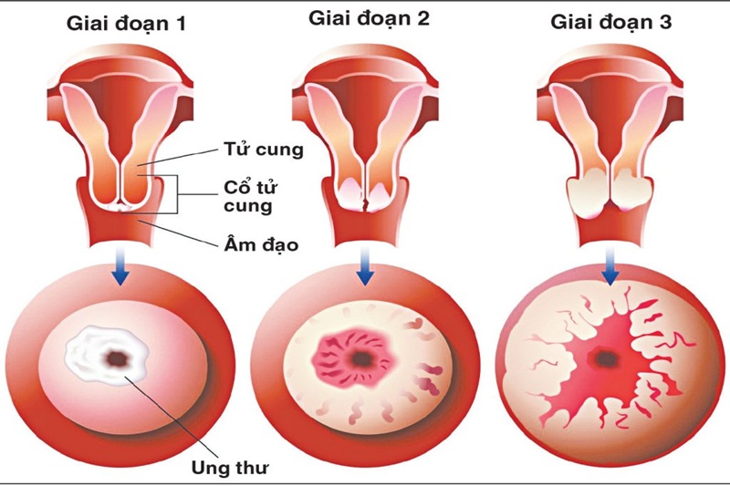 Các giai đoạn phát triển của tổn thương tiền ung thư đến ung thư