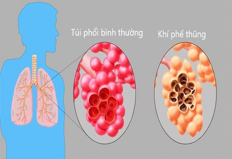 1. Khái Niệm Về Phế Nang