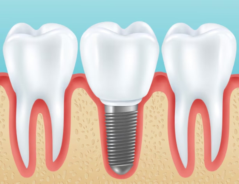 Trồng implant là biện pháp phục hình răng được áp dụng phổ biến