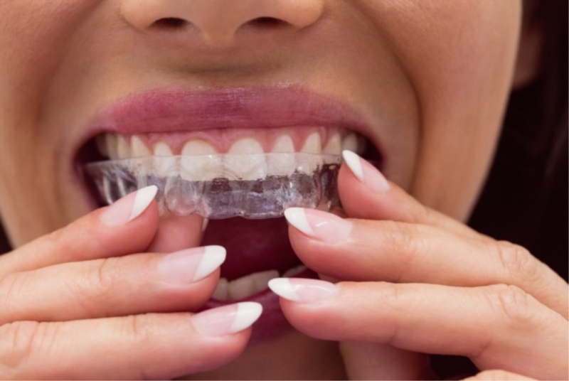 Cần kiên trì sử dụng để đảm bảo tác dụng của máng chống nghiến răng 