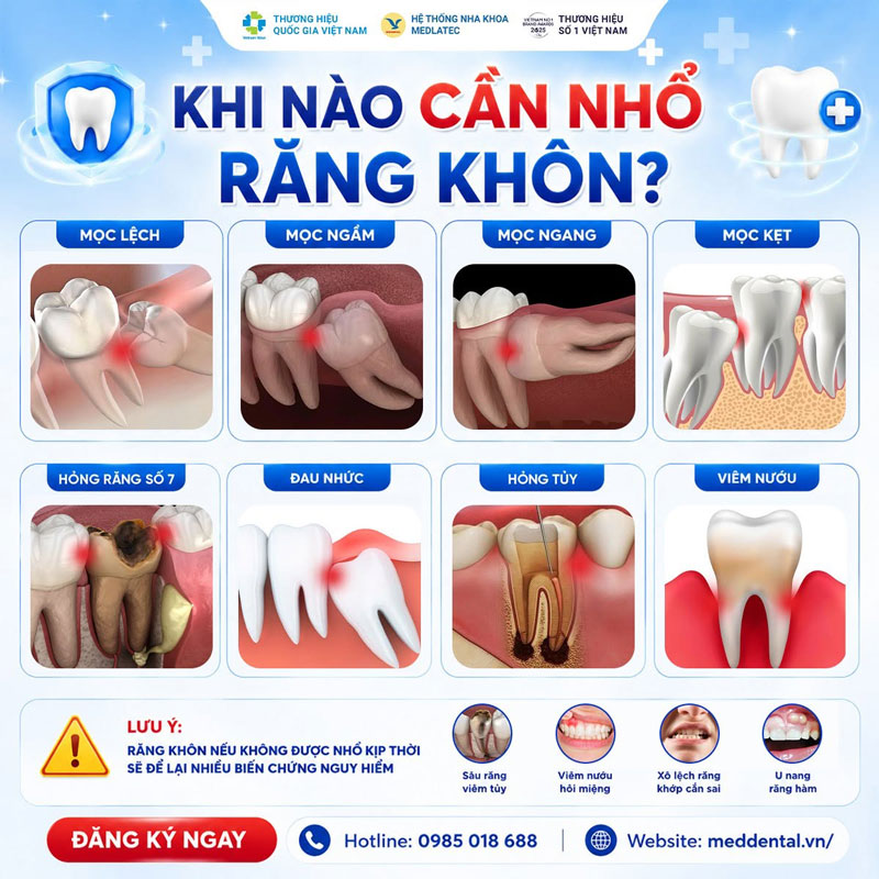 Có nhiều trường hợp cần nhổ răng khôn và đều phải thăm khám cẩn thận