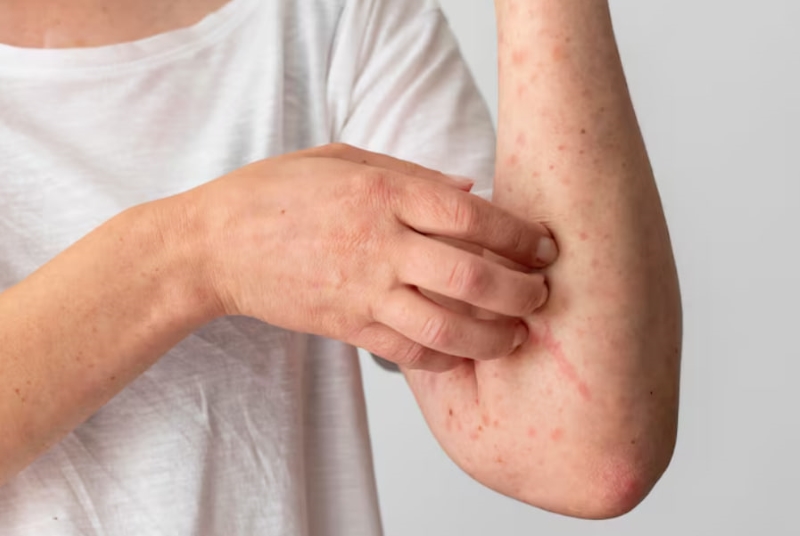 Lá trầu không có thể gây dị ứng đối với những người mẫn cảm