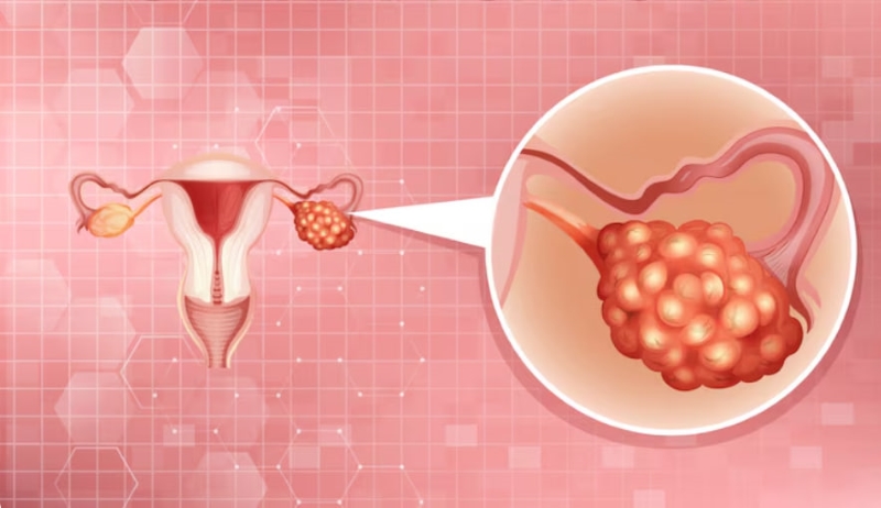 HPV là nguyên nhân chủ yếu gây ra ung thư cổ tử cung ở nữ giới