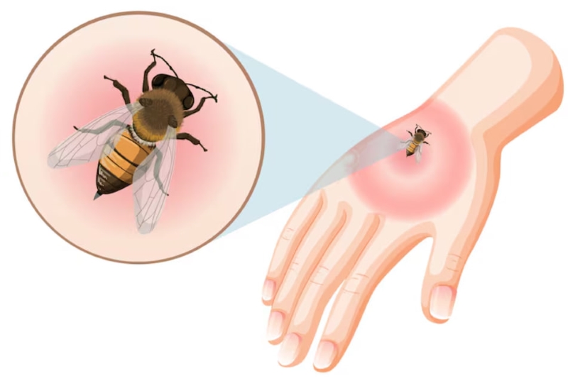 Ong đốt có thể gây ra biến chứng nghiêm trọng trong một số trường hợp