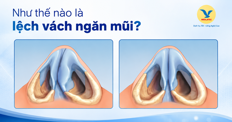 Lệch vách ngăn khiến hai bên hốc mũi mất cân đối, ảnh hưởng đến đường lưu thông không khí. Hình minh họa, nguồn AI
