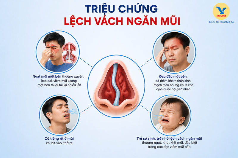 Một số triệu chứng thường gặp ở người bị lệch vách ngăn mũi. Hình minh họa, nguồn AI