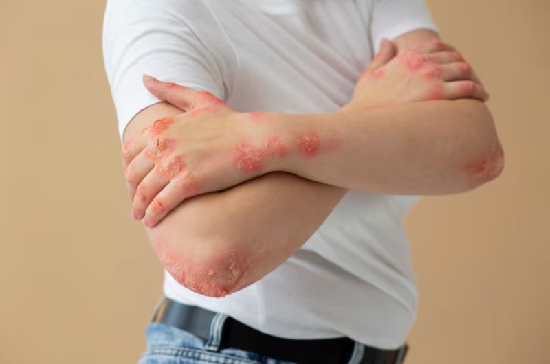 Người mắc zona thần kinh sẽ xuất hiện các mảng phát ban đỏ kèm mụn nước trên da 
