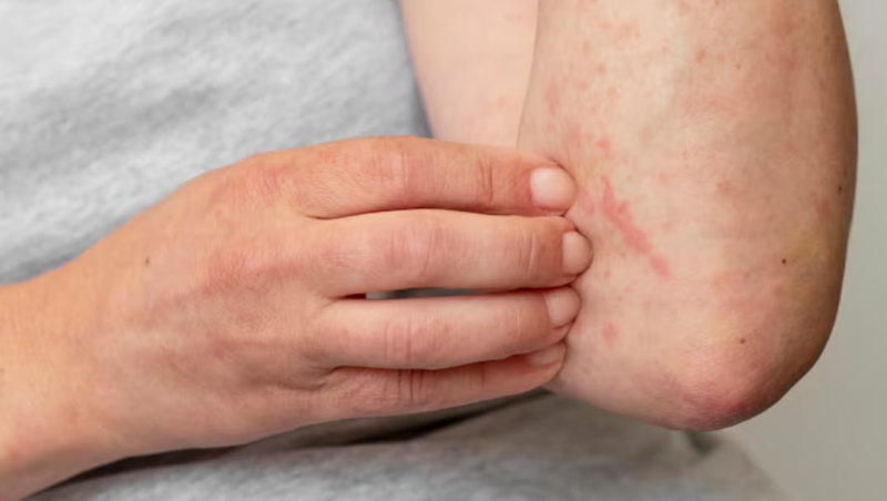 Zona thần kinh có khả năng để lại thâm và sẹo