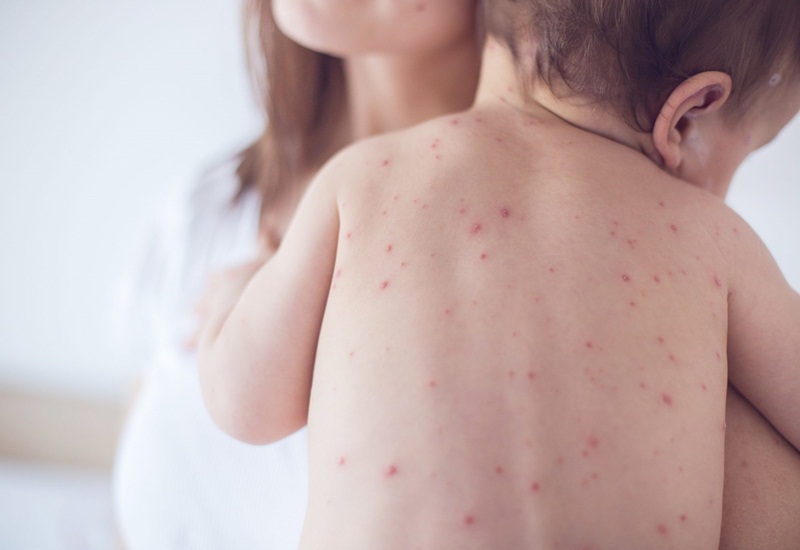 Các loại biến chứng trong diễn biến bệnh sốt xuất huyết ở trẻ em bạn cần biết