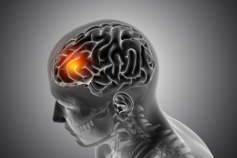 U máu thể hang não cũng là một trong những lý do khiến phim chụp MRI não trông giống tổ ong