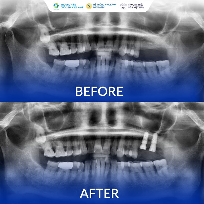 Trồng răng Implant là kỹ thuật phục hình răng hiện đại