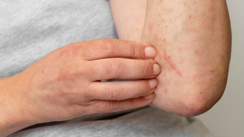 Uống nước rau kinh giới hỗ trợ điều trị dị ứng, nổi mề đay, rôm sảy