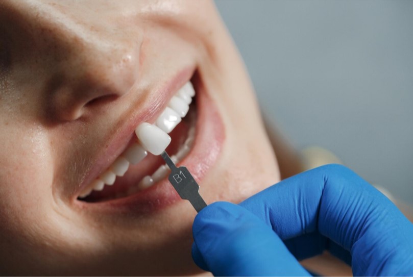Răng sứ Cercon mang lại tính thẩm mỹ vượt trội