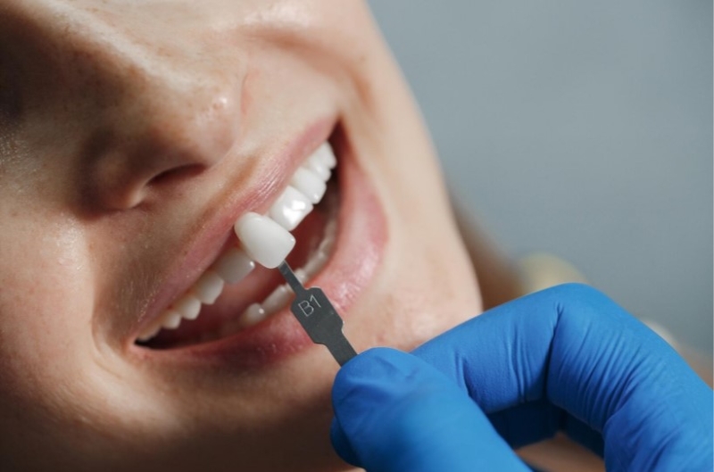Răng sứ Titan Vita (Đức) là một trong những dòng sản phẩm chất lượng cao 