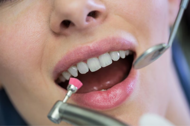 Dán răng sứ giá bao nhiêu - chi phí cần được cân nhắc dựa trên nhiều yếu tố