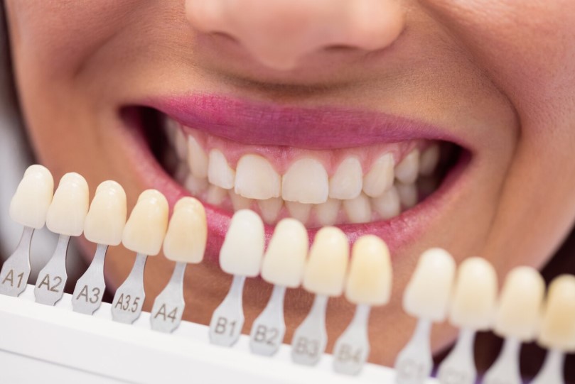 Dán răng sứ Veneer phù hợp với đối tượng răng ố vàng, xỉn màu 