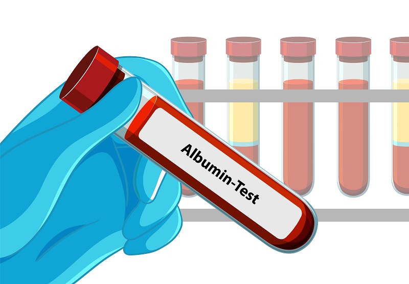 Nồng độ albumin trong xét nghiệm cung cấp căn cứ để bác sĩ đánh giá khả năng tổng hợp protein của cơ thể